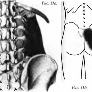 Болки в гърба, причинени Квадрат lumborum