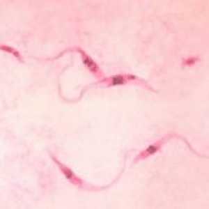 Chagas заболяване: симптоми, лечение, причините, диагноза, причини