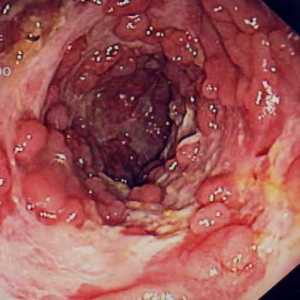 Болест на Crohn, рак на дебелото черво, симптоми и лечението