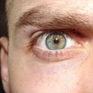 CMV ретинит: симптоми, лечение, диагностика, профилактика