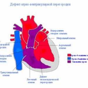 Камерни септален дефект на сърцето: причините, лечение, симптоми, признаци