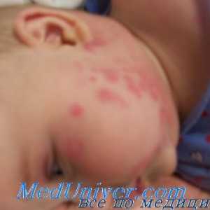 Диагностика на алергии и други странични ефекти на лекарства при деца