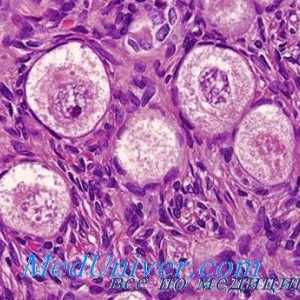 Disgerminoma семином или яйчниците. тумори на яйчниците Lipoidnokletochnye вирилизиращи