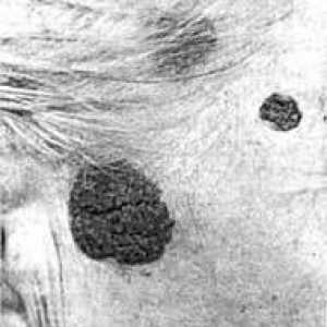 Доброкачествените тумори на кожата, главата и шията: пигментни невуси