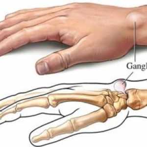 Доброкачествените тумори на меките тъкани на ръката: лечение, причините, симптоми, признаци