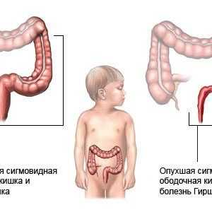Dolichosigma на червата при деца