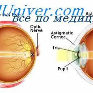 Контактни лещи. Vision с катаракта
