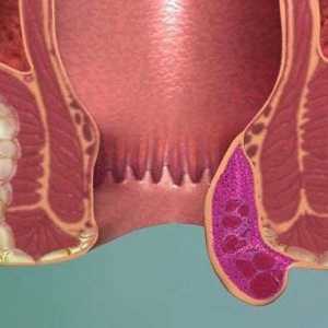 Хемороидалното тромбоза: етап, симптоми и лечение