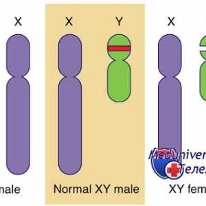 Генетични заболявания на половите жлези. Гените КРЗ, WT1 и синдроми Фрейзър и Денис-dresha