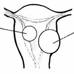 Хистероскопия в диагностиката и лечението на миома на матката