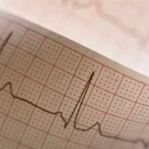 Електрически инфаркт на нестабилност: за лекуване, причини, симптоми, признаци