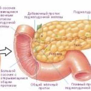 Ендокринната тумор на панкреаса