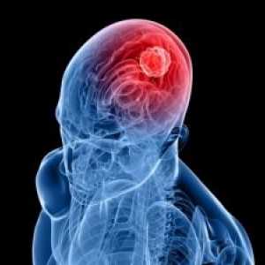 Епидурален хематом на мозъка: на симптоми, лечение, последствията