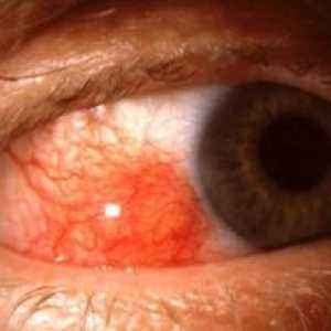 Еписклерит очите: лечение, симптоми, причини