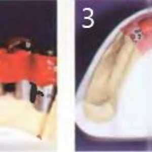 Етапи от производствения фиксирана протеза на долната челюст. Етапи 06 април
