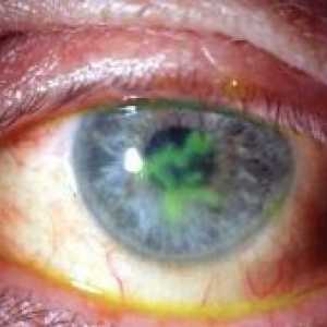 Кератитът очите: лечение, симптоми, причини, симптоми
