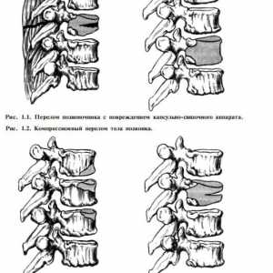 Класификацията на травми на гръбначния стълб и гръбначния мозък