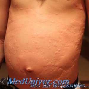 Болнични хранителни алергии. Алергия към храна при деца