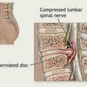 Компресия на гръбначния мозък (синдром): Симптомите, Лечение