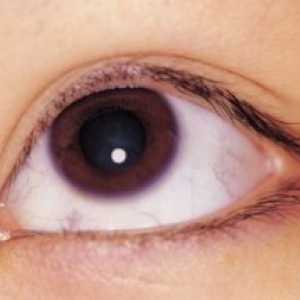 Boundary кератит очите: лечение, причини, симптоми