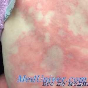 Лечение на алергии към лекарства при децата. Алергичен към пеницилин и други В-лактами