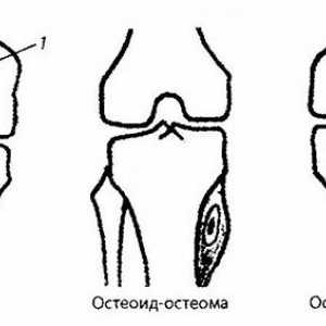 Радиационна и инструментална диагностика на колянната става патология. Тумор на колянната става
