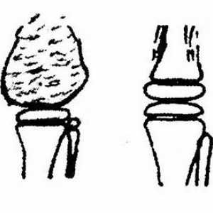 Радиационна и инструментална диагностика на колянната става патология. амелобластом