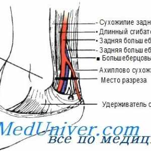 Метод задната тибиална артерия катетеризация от изолация