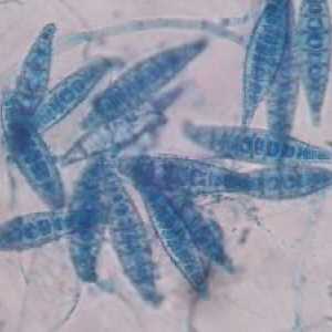 Microsporidiosis при хора: симптоми, лечение