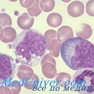 Нарушенията на Т-лимфоцити. CD8 лимфопения