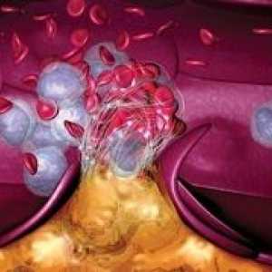 Наследствени заболявания на тромбоцитите интериор