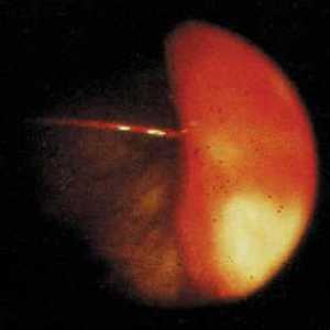 Офталмология компютърно термография при диагностицирането на злокачествени тумори на очите и…