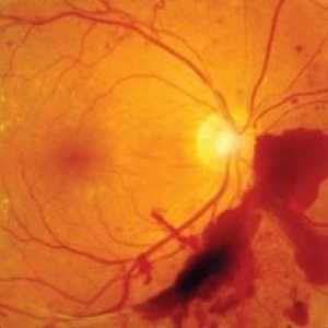 Оклузия на централната ретинална артерия: лечение, причини, диагноза