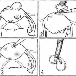 Хирургия на матката. лапароскопска миомектомия