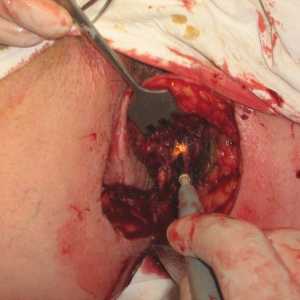 Операция за отстраняване на хемороиди и анални фисури