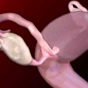 Тумори на яйчниците при жените доброкачествени и злокачествени: симптоми, лечение, симптоми, причини
