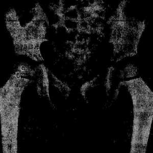 Остеолиза на ерозия на костта