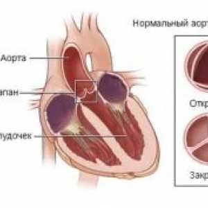 Остра дисфункция на сърдечните клапи