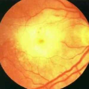 Остра ретината некроза: симптоми, лечение, причините, симптоми