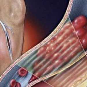 Остра тромбоза на дълбоките вени на долните крайници: лечение, симптоми