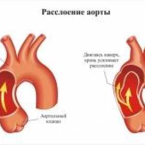 Аортната патология по време на бременност