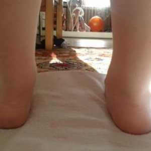 Ploskovalgusnaya крак при деца, лечение