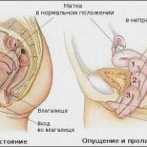 Малформации на матката: диагностика и лечение