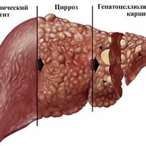 Opisthorchiasis последици при възрастни, въздействието върху човешкото тяло