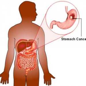 Рак на стомаха: патогенеза, хистология, колко време