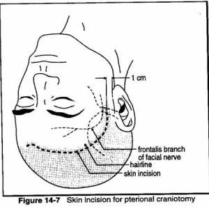 Разрезите (pterional краниотомия)