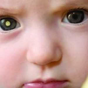 Retinoblastoma при деца: симптоми, лечение, причини, симптоми