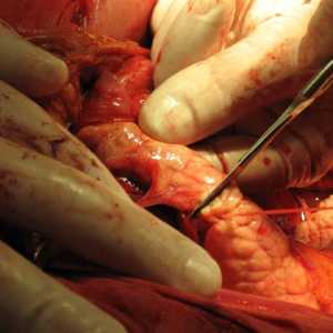Резекция на главата и опашката на панкреаса дисталния и неговите последици