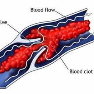 Ролята на морфологични и функционални фактори в развитието на тромбоза