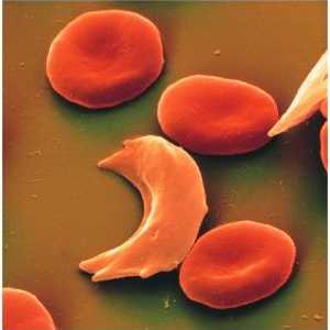 Сърповидно-клетъчна анемия: симптоми, причини, лечение, симптоми